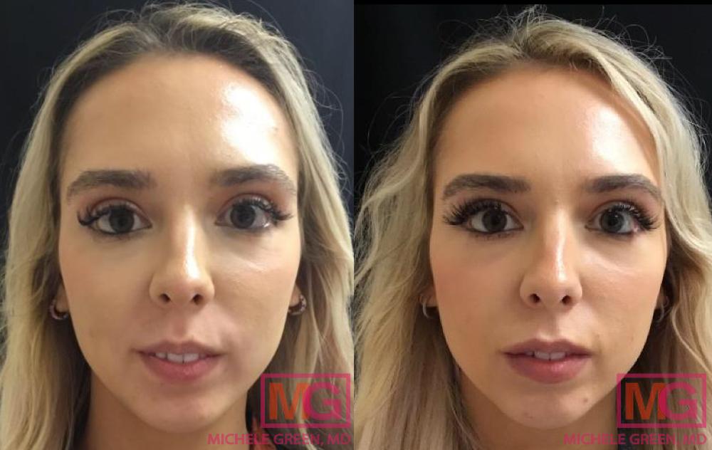 P.C 28yr old female Before After Juvederm Ultra Plus MGWatermark
