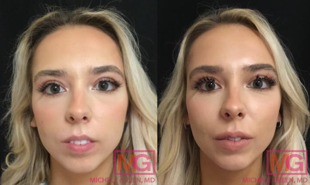 P.C 28yr old female before After Botox lip flip MGWatermark