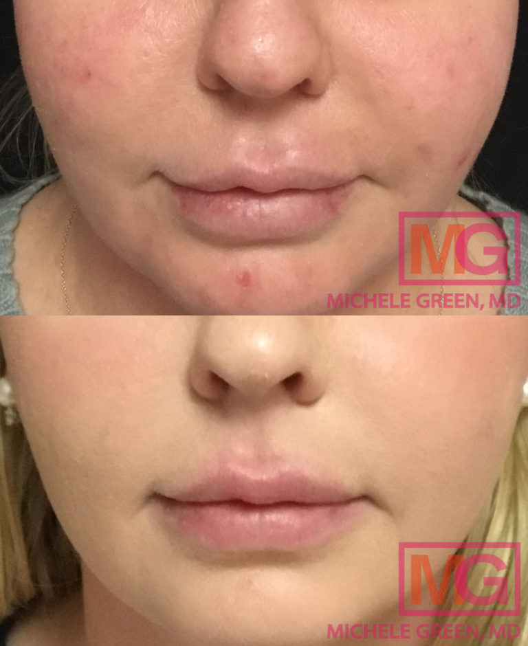 Lip Fillers Before & After Photos Dr. Michele Green M.D.