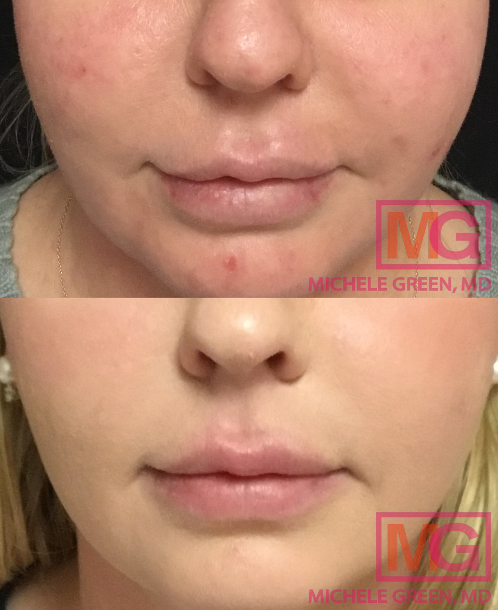 What is the Botox Lip Flip Procedure? Dr. Michele Green M.D.