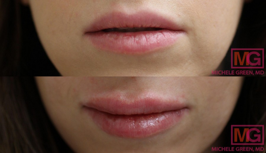 Juvederm Ultra Plus for Lip Injections