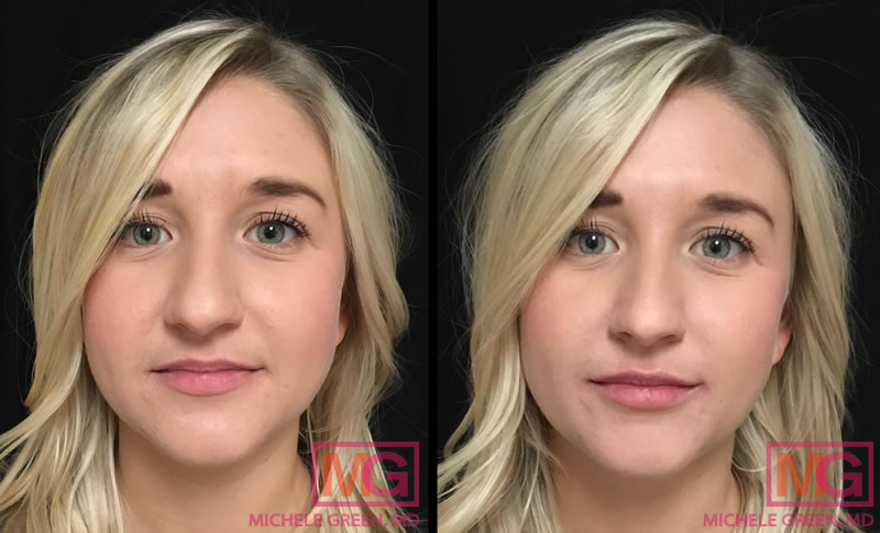 Female 25-34 year old, Restylane for Lips