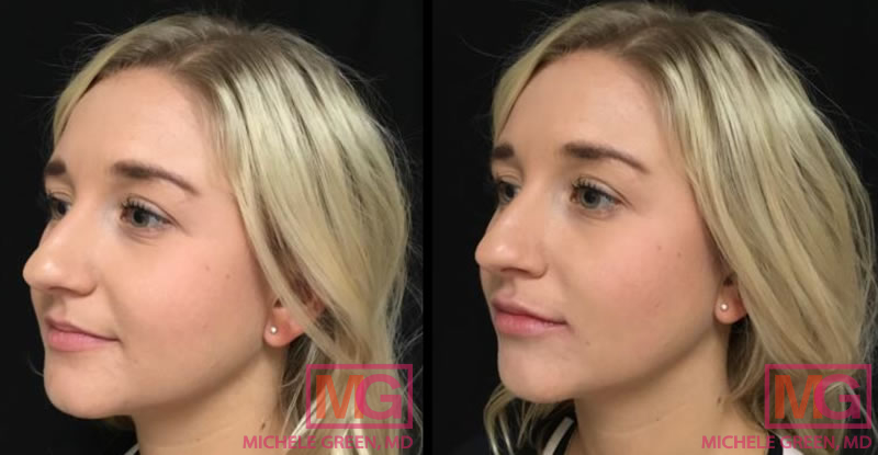 PA restylane 1 syringe lips before after LANGLE MGwatermark