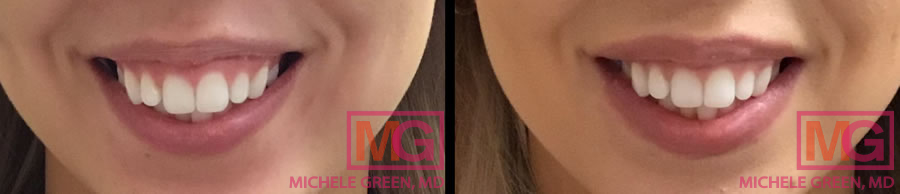PC botox lip flip 2 MGwatermark