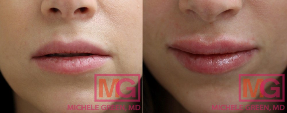 PS 40yr juvederm ultra plus