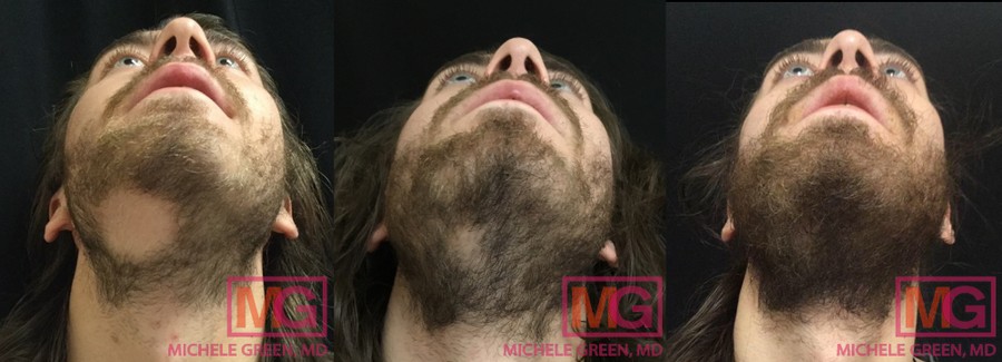 R.O 3 month Before and After Cortisone Injection for Hairloss Under chin 3 photos MGwatermark 1