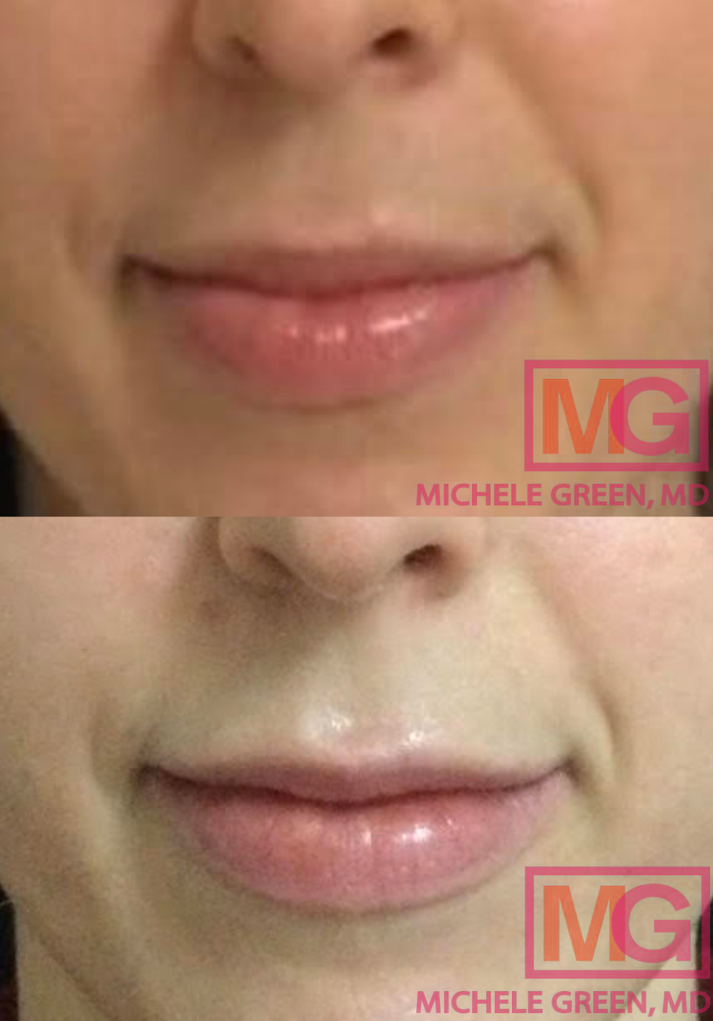 RL 30yo female before after Botox lip flip and 1 syringe of Restylane li...