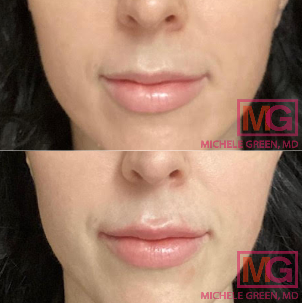 Restylane and Botox in Lips