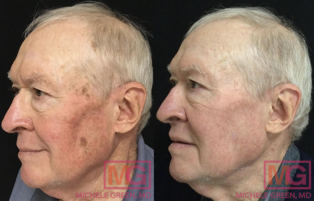 RL 74yo male before and after ED AlexTrivantage and Fraxel LEFT MGWatermark