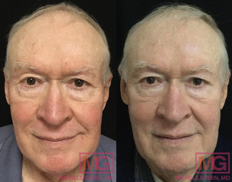 RL 74yo male before and after ED AlexTrivantage and Fraxel MGWatermark