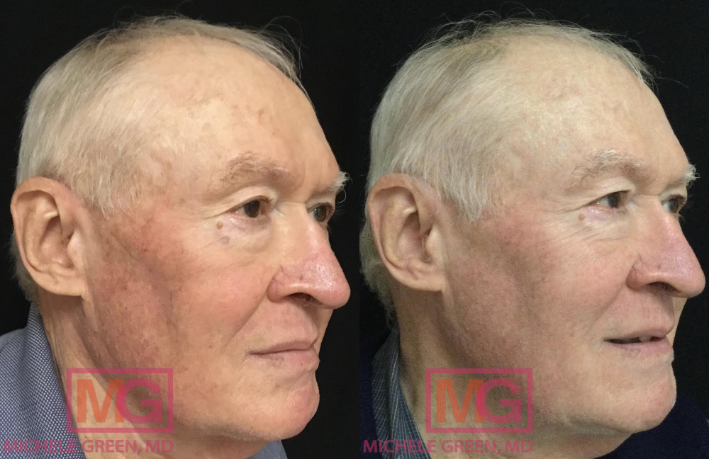 RL 74yo male before and after ED AlexTrivantage and Fraxel RIGHT MGWatermark