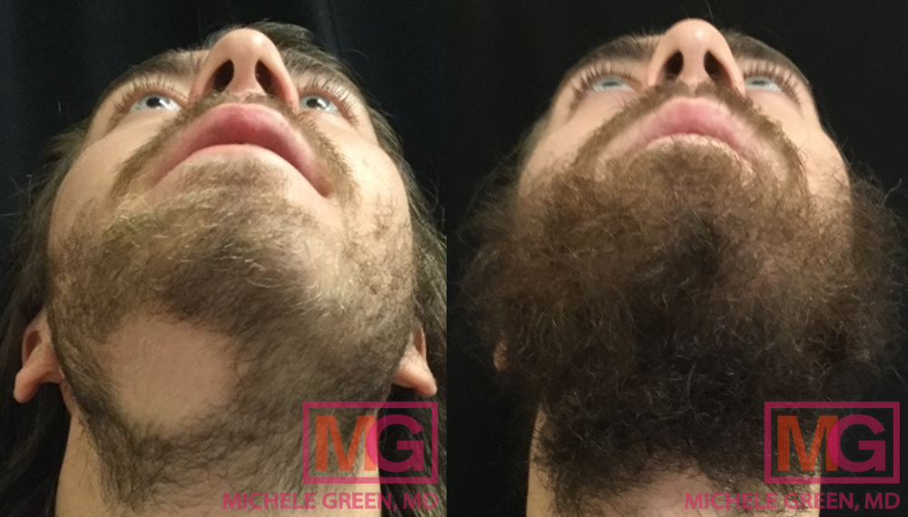RO 24 yr before and after Kenalog injection alopecia beard MGWatermark