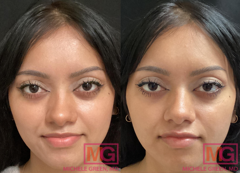 RS 24 yo female before after Juvederm lips MGWatermark