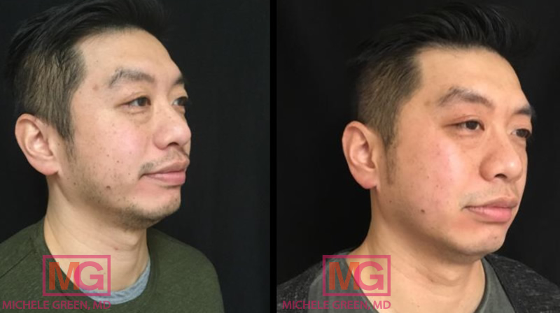 35-44 year old male – mole removal via Electrodessication