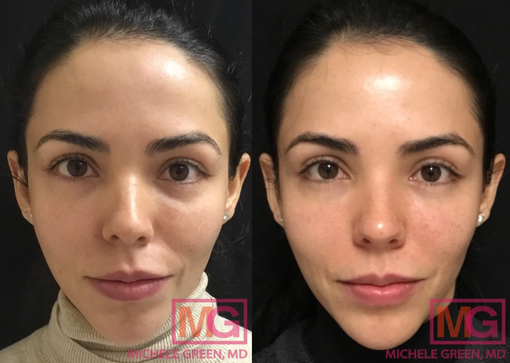S.G 1 Month Before and After Juvederm Voluma Cheeks 2 syringes RestylaneUnder the Eyes NL 1 syringe 1 MGWatermark
