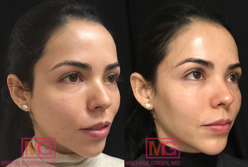 S.G 1 Month Before and After Juvederm Voluma Cheeks 2 syringes RestylaneUnder the Eyes NL 1 syringe ANGLER MGWatermark