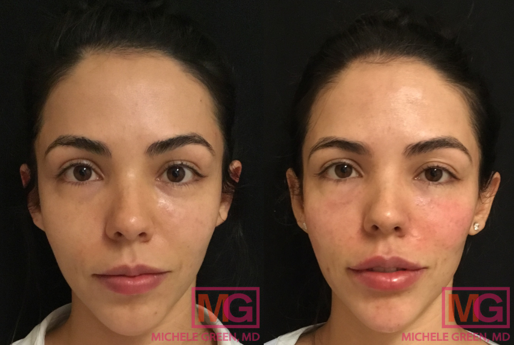 S.G 2 weeks Before and After Restylane Lips 1 syringe MGWatermark