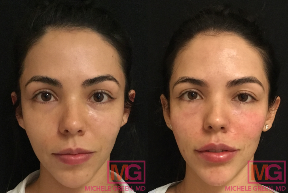 S.G 2 weeks Before and After Restylane Lips 1 syringe MGWatermark