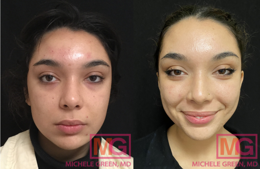 S.P Before and After Accutane MGWatermark