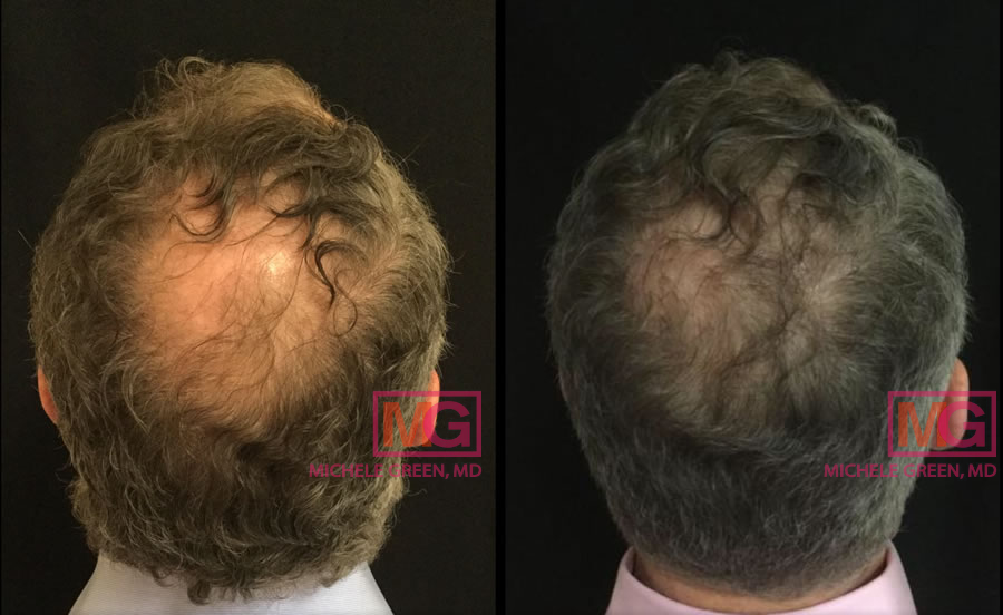 48 year old treated with PRP for Hair Loss