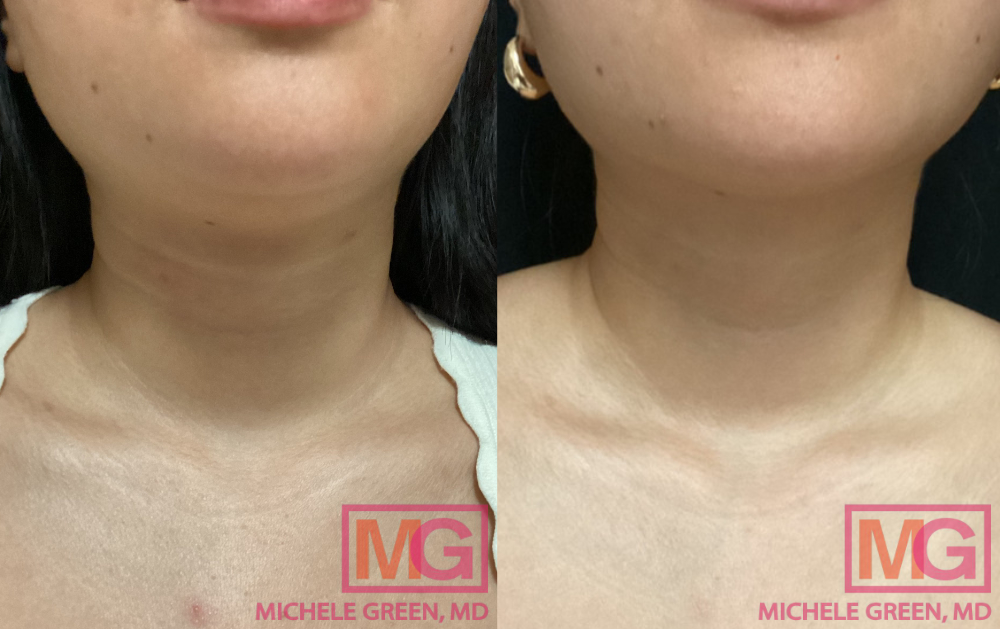 SC 29 yr old female before and after sculptra on the neck MGWatermark