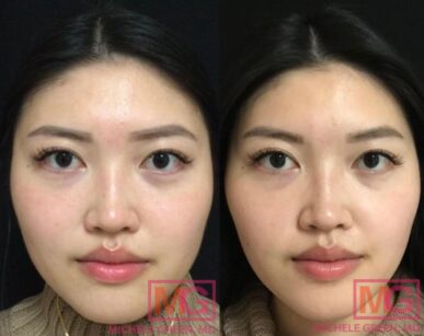 Face Slimming Botox, Botox for Facial Slimming - Dr. Michele Green M.D.