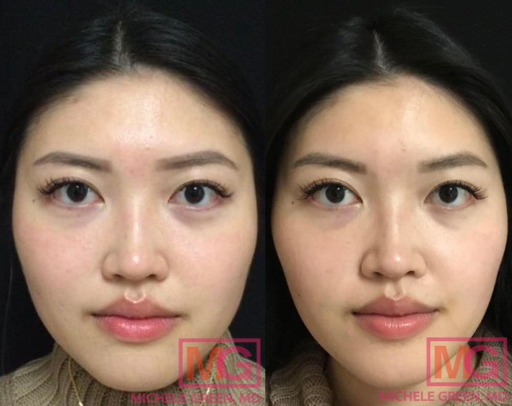 Female before and after 1 treatment Botox Masseter