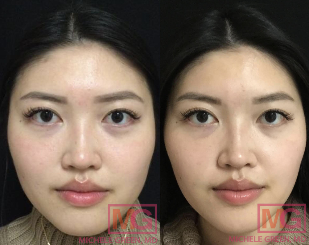 SC Before and after 1 treatment botox masseter MGWatermark