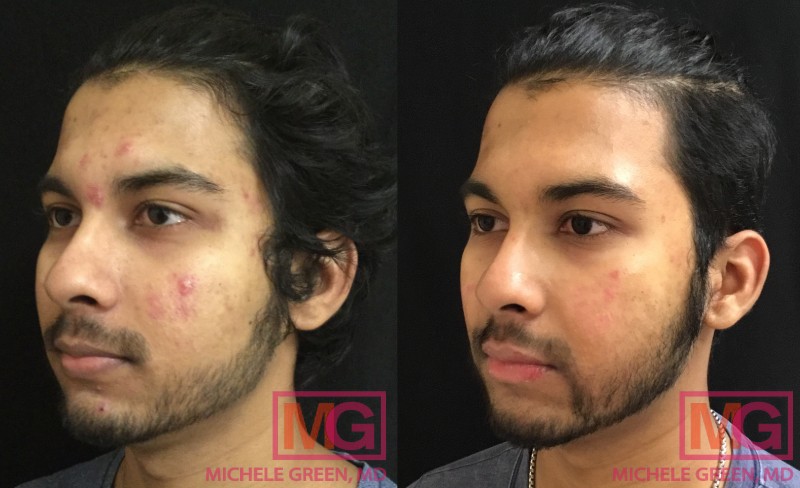 Microneedling Before & After Photos - Dr. Michele Green M.D.