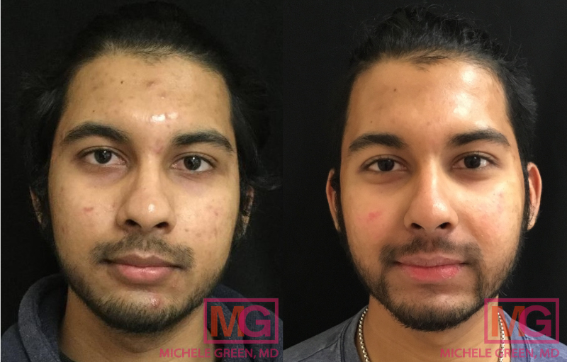 23 year old, 6 Months before and after Accutane
