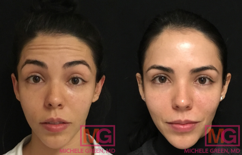 SG 27 3 weeks Before and After Botox MGWatermark