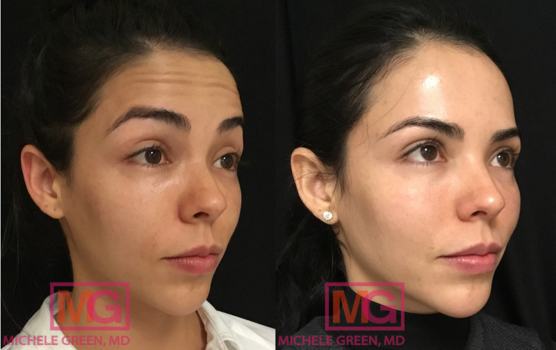 SG 27 3 weeks Before and After Botox RIGHT MGWatermark