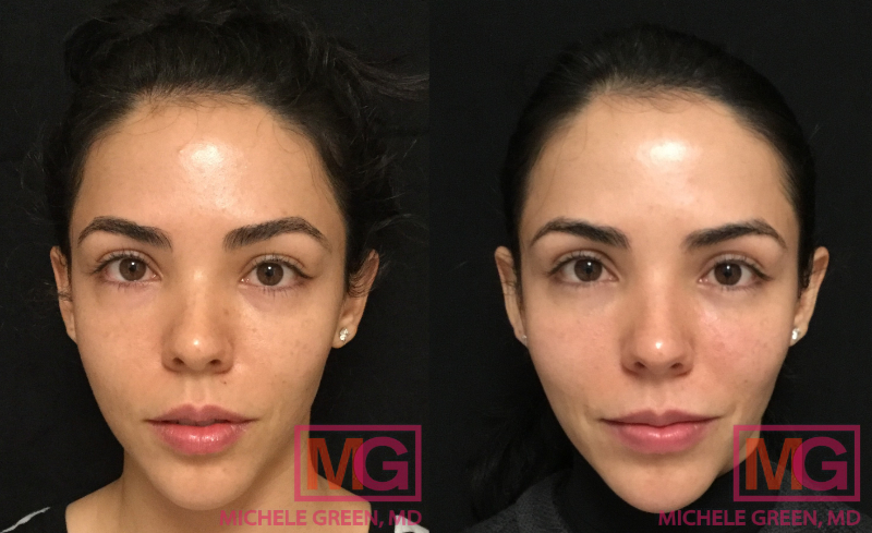 SG 27 4 weeks Before and After Belotero 1 syringe Under Eyes MGWatermark 1