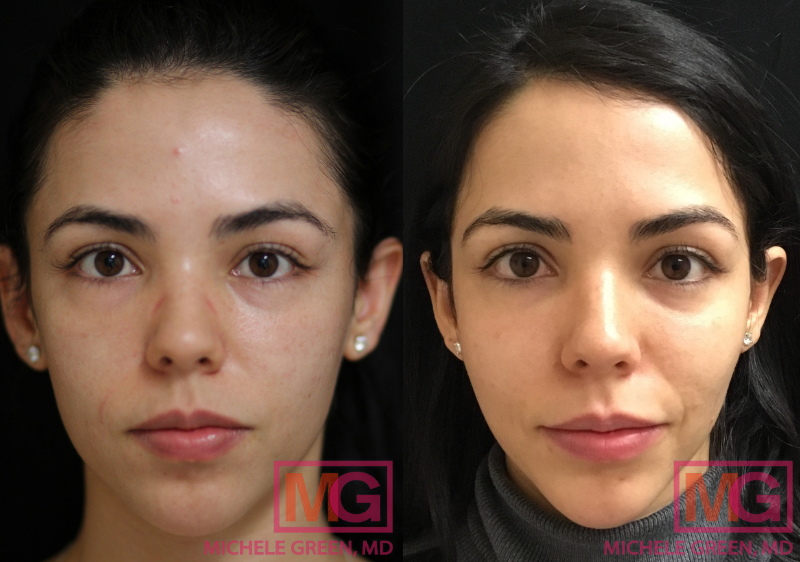 5 month Before and After Microneedling with PRP