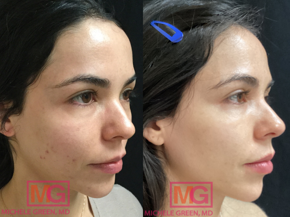 SG 31 yo female before after microneedling w depigmantation serum MGWatermark