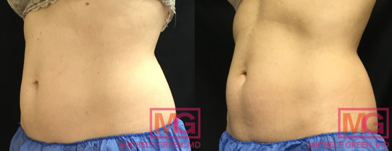 SG 48F 3 Months Before and After Coolsculpting Advantage x1 Lower Abdomen Petite x2 Flanks ANGLE L MGWatermark
