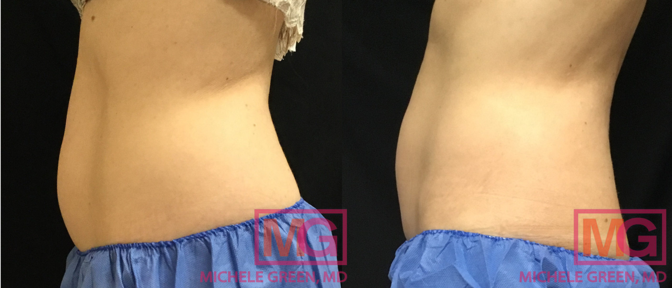 SG 48F 3 Months Before and After Coolsculpting Advantage x1 Lower Abdomen Petite x2 Flanks PROFILE L MGWatermark