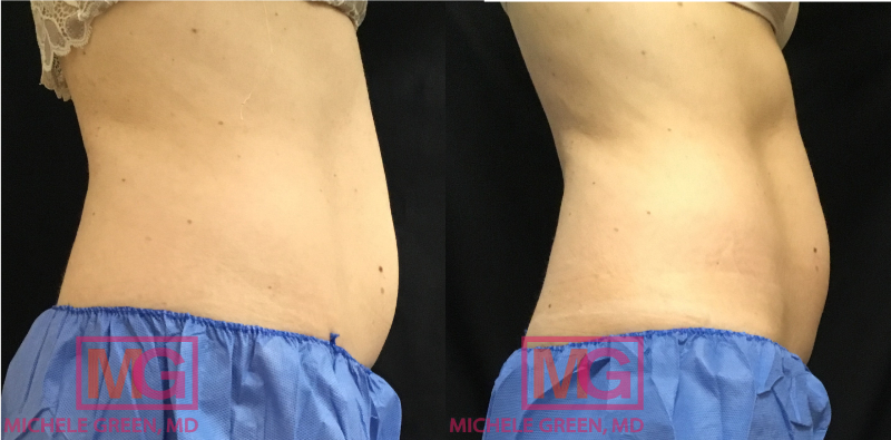 SG 48F 3 Months Before and After Coolsculpting Advantage x1 Lower Abdomen Petite x2 Flanks PROFILE R MGWatermark