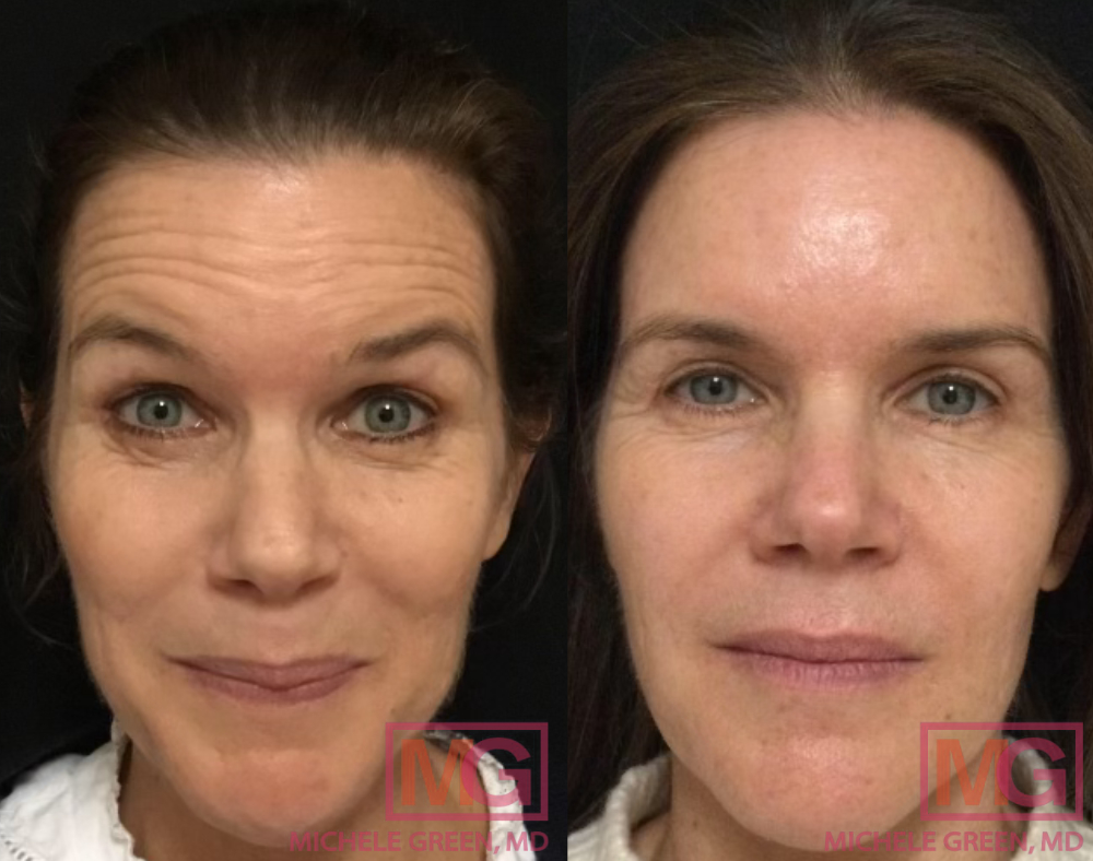 50 year old - Botox 2 weeks
