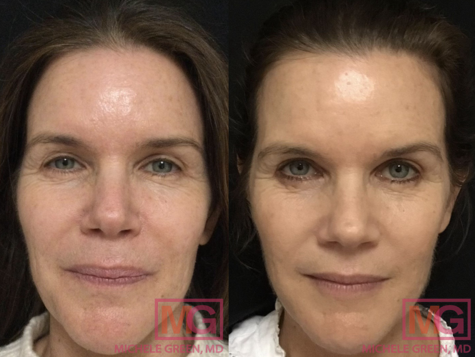 VBeam & Botox - 6 months before and after