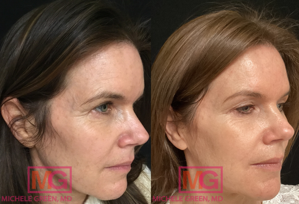 51 yo female Before & After Botox & Fraxel Treatments