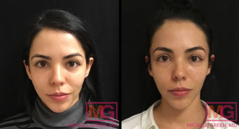 Microneedling Before & After Photos - Dr. Michele Green M.D.
