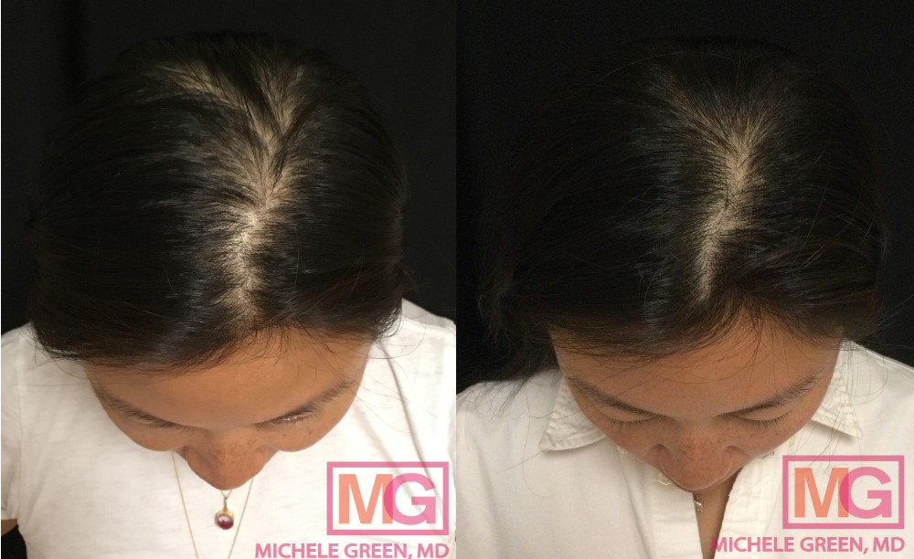 Postpartum Hair Loss, Pregnancy Hair Loss - Dr. Michele Green M.D.