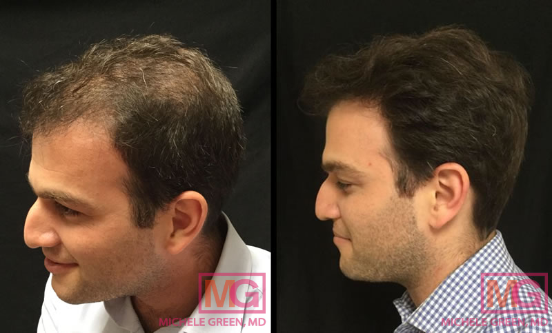 Male with PRP treatment on hair – 4 months