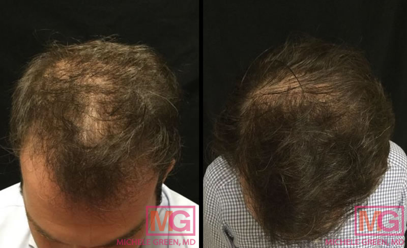 Male with PRP treatment on hair – 4 months