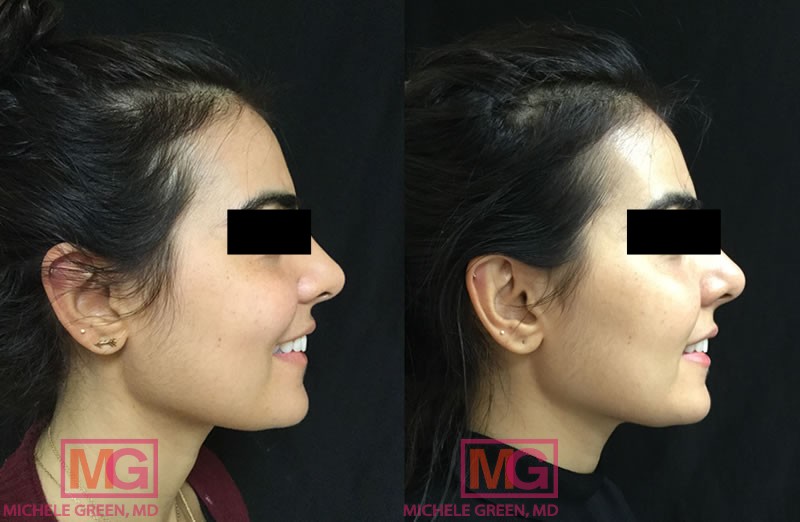 34 year old female after chemical peels