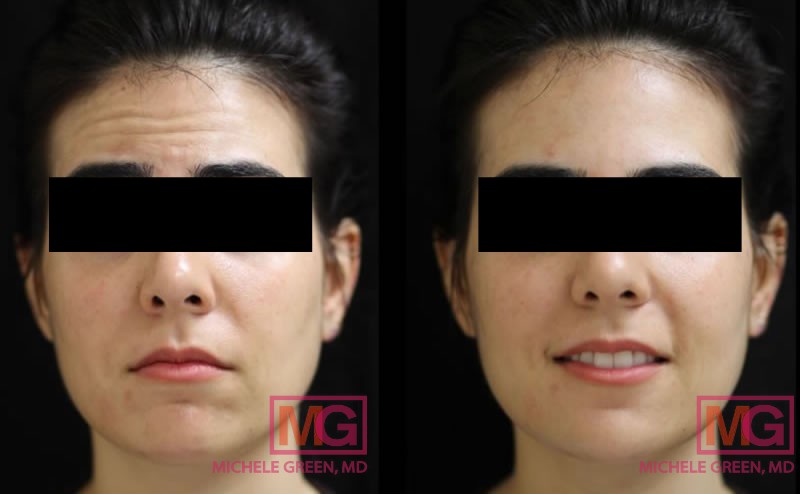 SJ 35 botox 2 week fore glabella crows ba FRONTALT BLACK BOX EYES MGwatermark