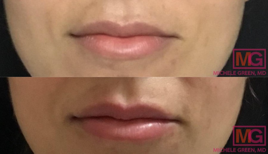 Restylane treatment for lips