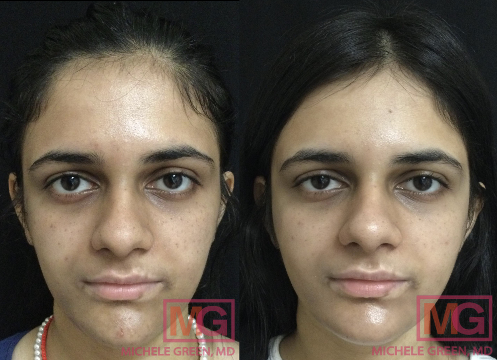 20 year old female before and after Cosmelan treatment - 5 months