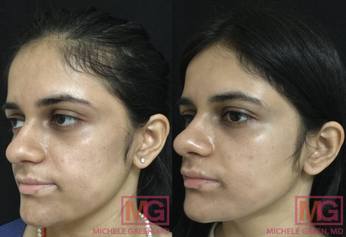 20 year old female before and after Cosmelan treatment - 5 months